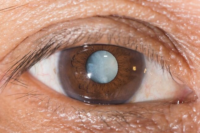 For cataracts, exercises are recommended to improve vision.