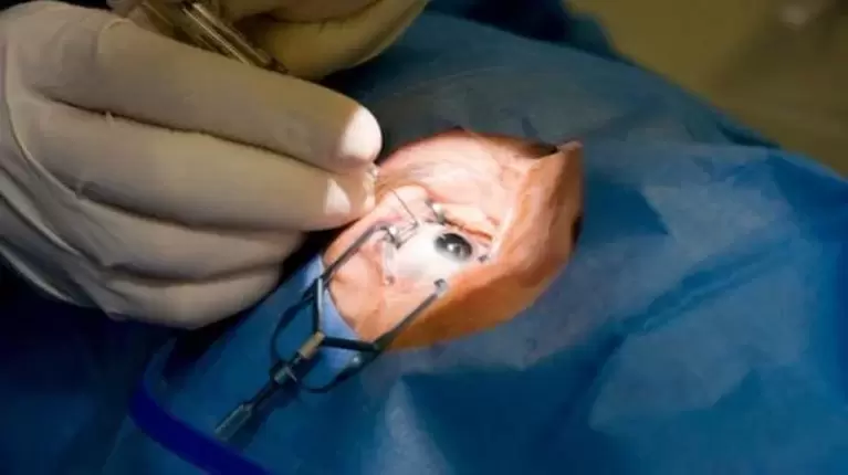 Vitrectomy – removal of the vitreous humor of the eye